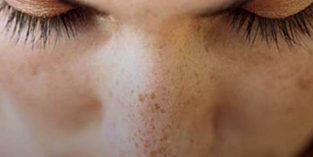 Cilt lekelerini yok edici kür!