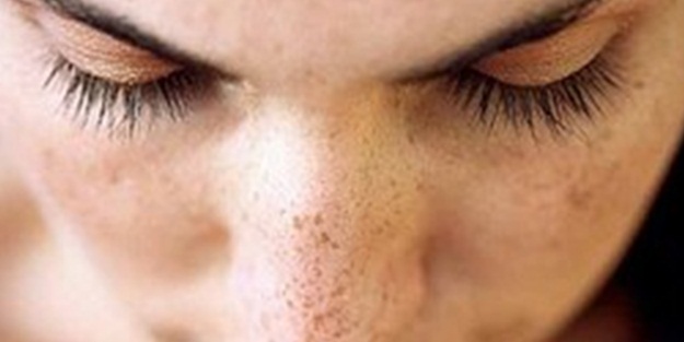 Cilt lekelerini yok edici kür tarifi