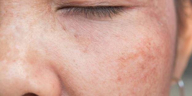 Cilt lekesi deyip geçmeyin! Bakın altından neler çıkıyor