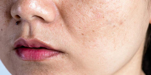 Cilt lekesi neden olur, nasıl geçer? Cilt kanseri nedenleri, belirtileri, tedavisi