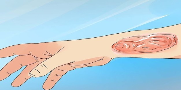 Cilt yanığına ne iyi gelir?