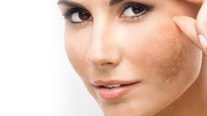 Ciltteki kahverengi lekeleri yok eden 10 doğal kür: Elinde yapıyorlar! Bu detayı kimse bilmiyor