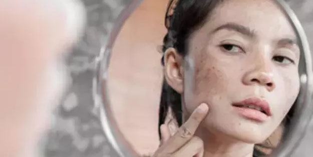 Ciltteki lekelenme bakın neden oluyormuş? Ayna gibi parlatıyor!