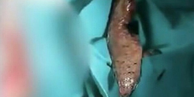 Çin'de akılalmaz olay! Bağırsağından çıkarıldı