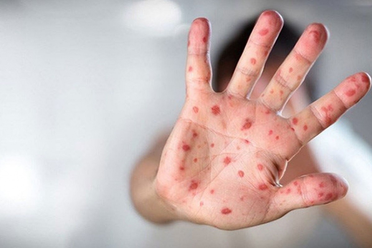 Çin'de ilk maymun çiçeği vakası