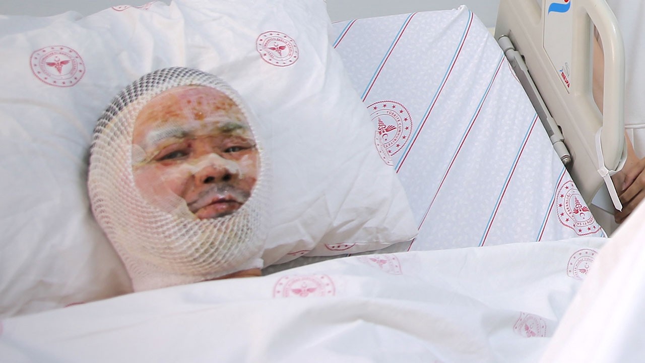 Çin'den geldi, Ağrı'da vücudu yandı, Van'da tedavi ediliyor