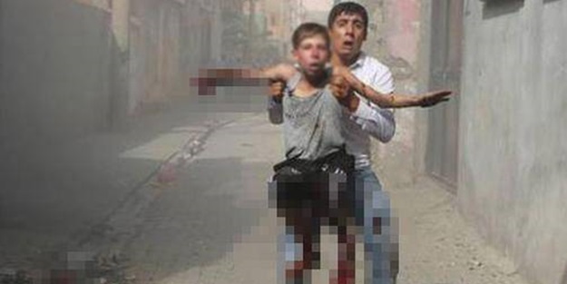 PKK bombası bir çocuğun elini kopardı!