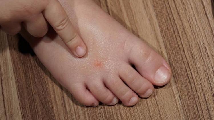 Çocuğunuzu sinek ısırdıysa dikkat!