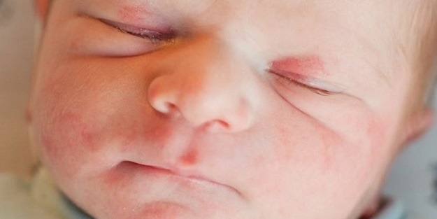 Çocuklarda doğum lekelerine dikkat