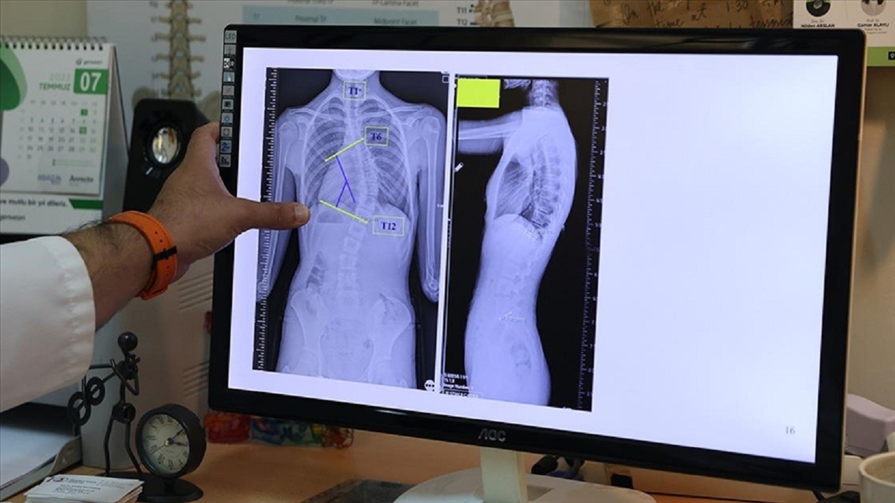 Çocuklarda gizli tehlike: Skolyoz