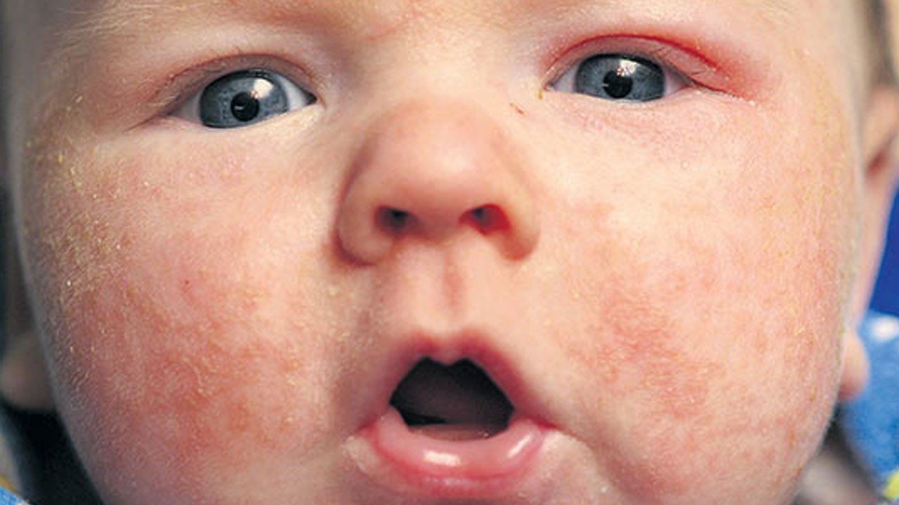 Çocuklarda kırmızı döküntülere dikkat! Nefes darlığıyla birlikteyse hemen hastaneye gidilmeli