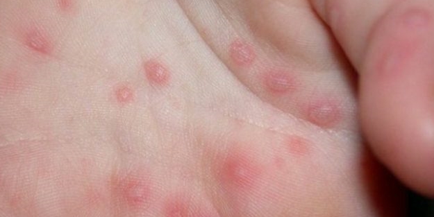 Çocukları sakınmamız gereken bir bulaşıcı hastalık daha ortaya çıktı
