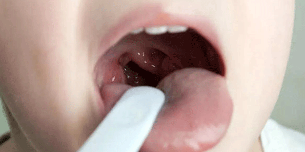 Çocukları tehdit eden bakteri hızla yayılıyor! Strep A'dan korunmak için dikkat edilmesi gerekenler