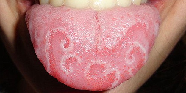 Coğrafik dil hastalığı - FOTO