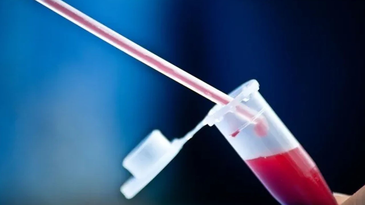 Çok sayıda kişide var! Bu kan grubuna sahipseniz bunama riskiniz: %82 olduğu ortaya çıktı