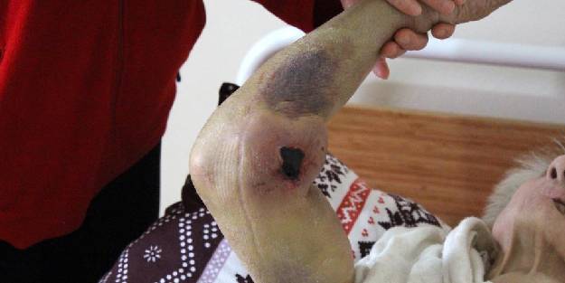 Covid-19’u yense de vücudunda oluşan yaralar tedirgin etti