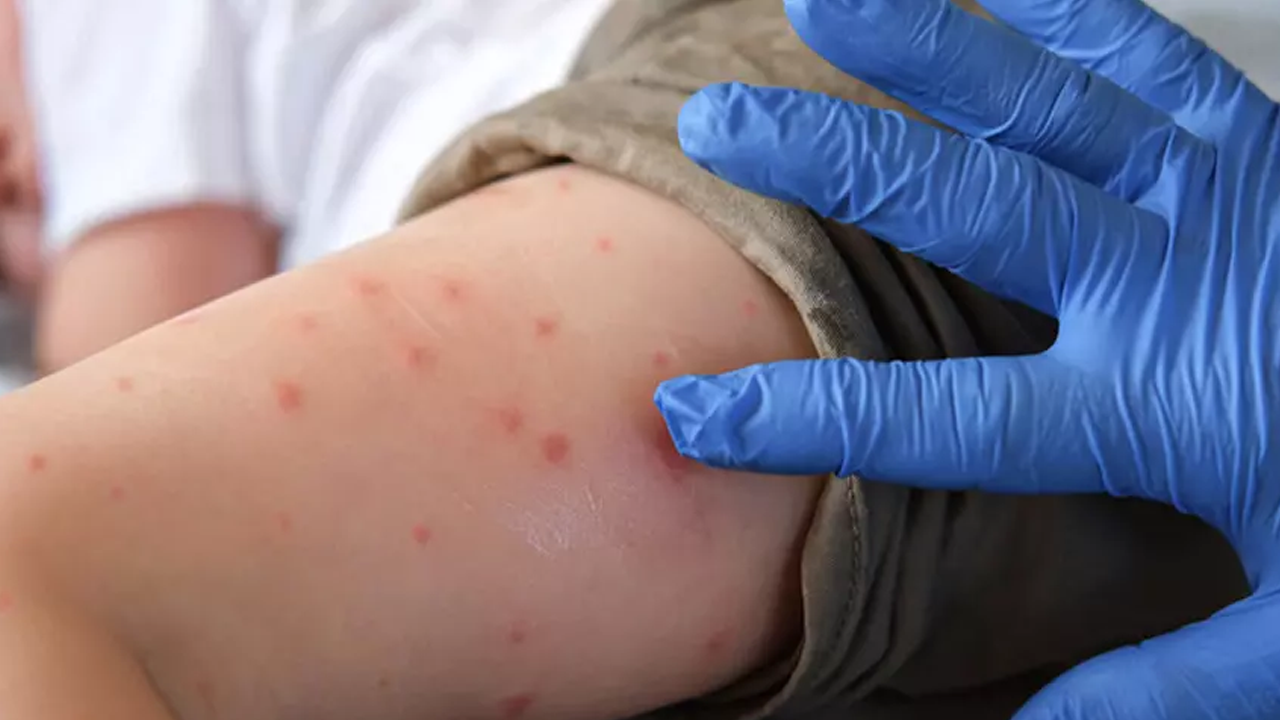 Covid gibi başa bela olabilir! Çin'de bir hastalık daha yayılıyor!