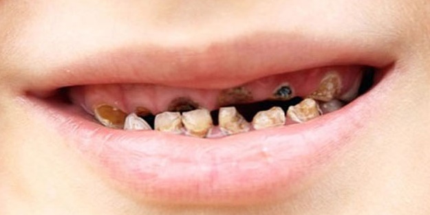 Çürük diş çocuğun sağlığını etkiliyor