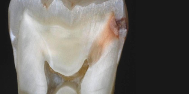 Çürük dişi ağzınızda tutmayın!