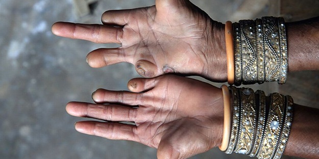 Cüzzam nasıl bulaşır?