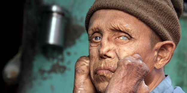 Cüzzam'dan nasıl korunulur?