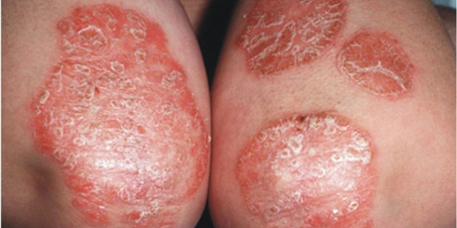 Sedef hastalığının nedenleri ve belirtilerini söyledi