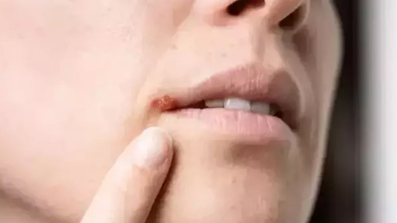 Daha fazla Alzheimer riski! Uçuklarınız bu şekilde çıkıyorsa: Beyni gizli gizli tehdit ediyor