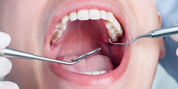 Damak yaralarına doğal çözüm