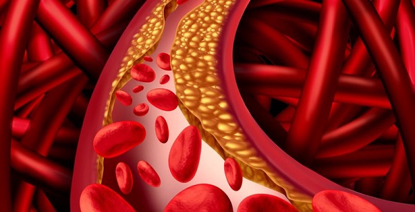 Damar sertliği nedir? Damar sertliği belirtileri nelerdir? Damar sertliği riskleri ve tedavi yöntemleri nelerdir?