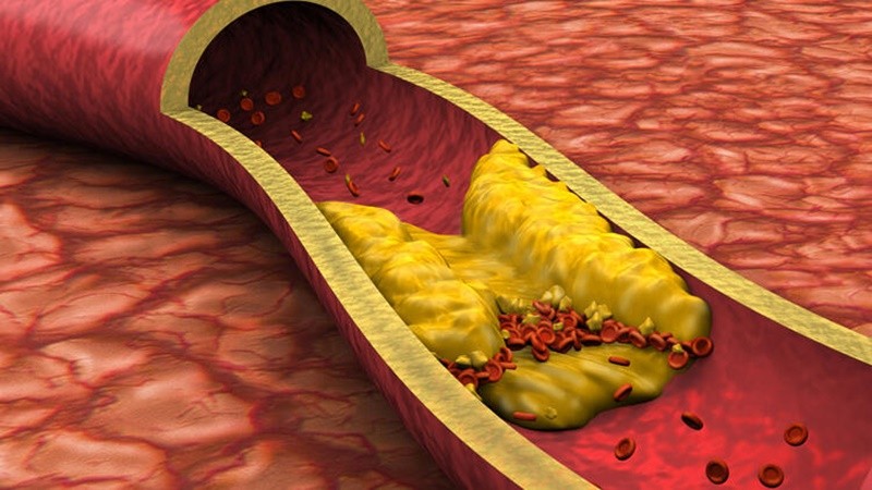 Damar tıkanıklığına birebir! Bu besinler hayat kurtarıyor
