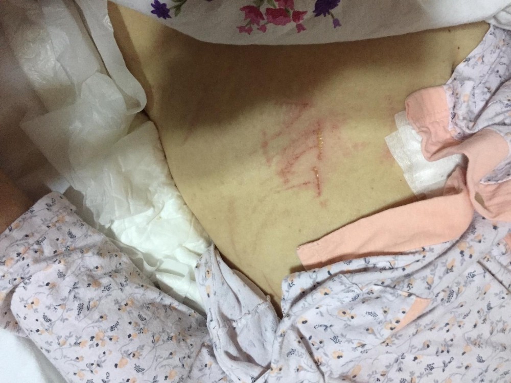 Denizli’de yatalak ALS hastasının karnına tırnakla ‘ATT’ yazıldı iddiası 