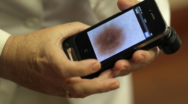 Deri kanseri teşhisinde yapay zeka insanlardan daha başarılı oldu