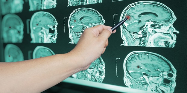 Dikkat beyin kanamasına yol açıyor! Hipertansiyon hastalarının kulağına küpe olsun