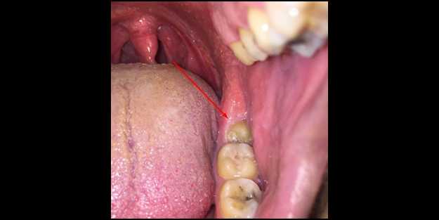 Dikkat! Bu belirtiler varsa dişinize diş kurdu girmiş olabilir