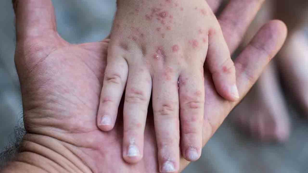 Dikkat! Bu virüs çocuklarda hızla bulaşıyor!