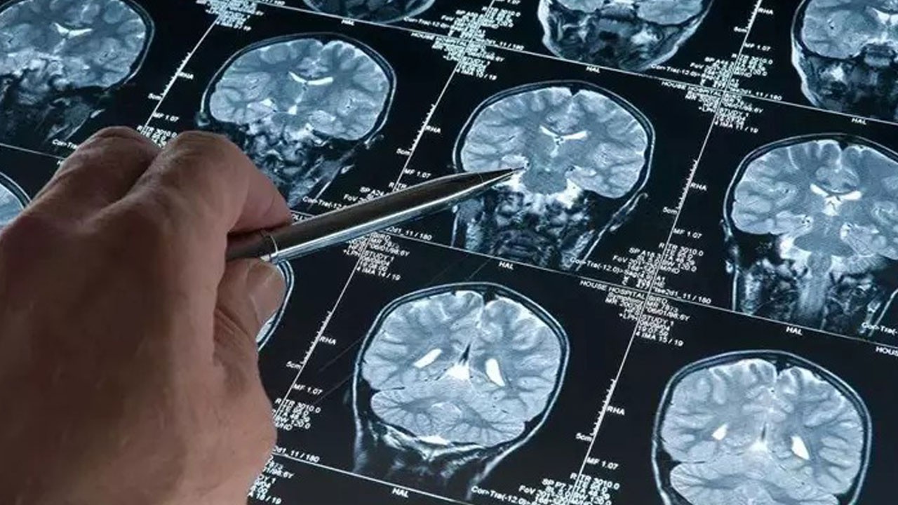 Dikkat çeken araştırma! Uyku ilacı Alzheimer’a karşı umut ışığı olabilir mi?