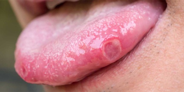 Dil yarasına ne iyi gelir? Dil yarası nasıl geçer?