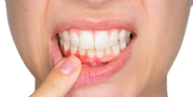 Dildeki aft, pamukçuk ve uçuk nasıl geçer?