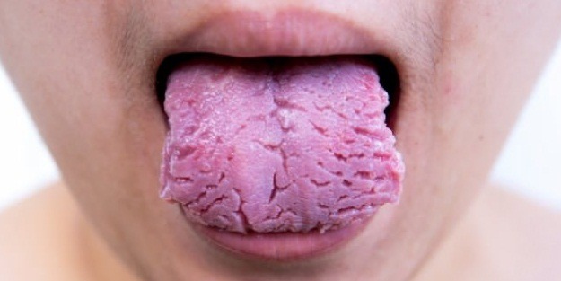 Dildeki yaralar bunun habercisi olabilir