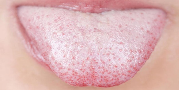 Dilin üzerinde beyaz bir tabaka varsa...