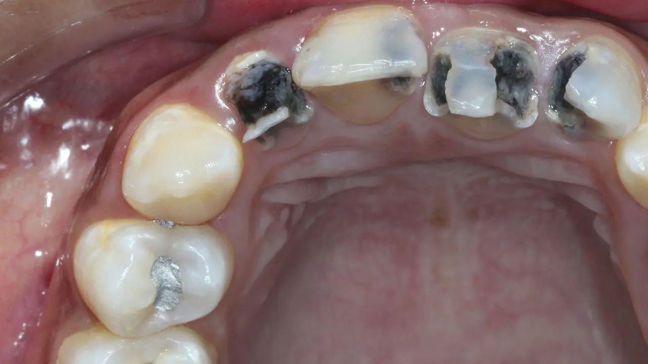 Diş çürüğü sorunu olanlar dikkat! Ortaya çıktı! O hastalığı tetikliyor!