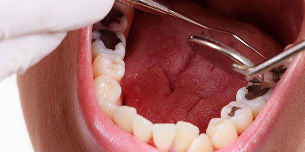 Diş çürüklerini durduran 10 bitki