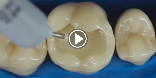 Diş dolgusu nasıl yapılır?