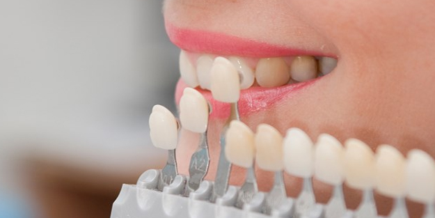 Diş estetiği nedir? Diş estetiği nasıl yapılır? Diş estetiği dolgu