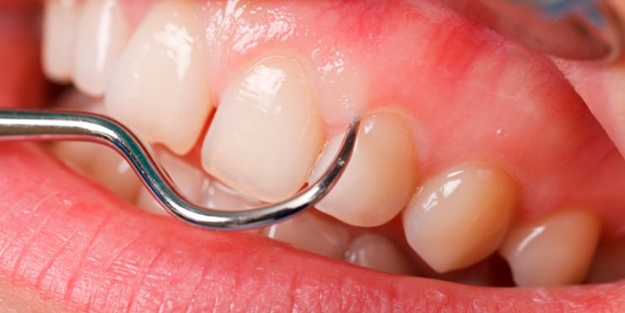 Diş eti büyümesi hastalık habercisi