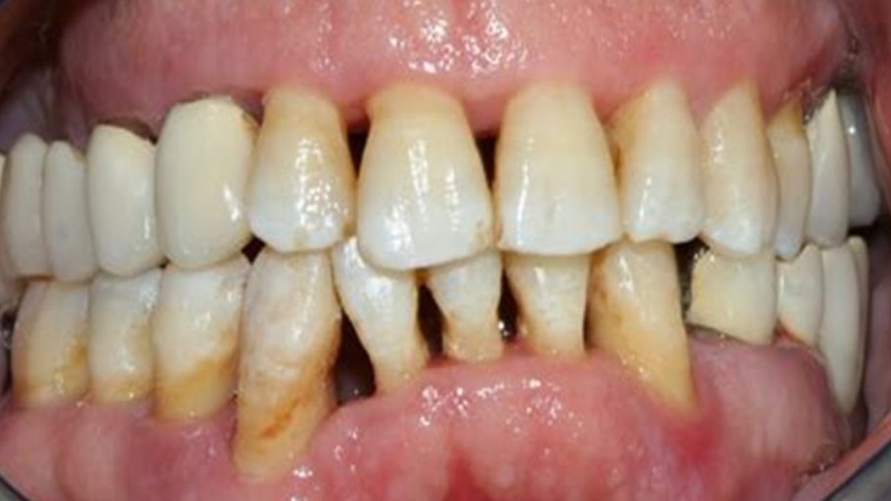 Diş eti çekilmesini önleyen, iltihap kurutan kür