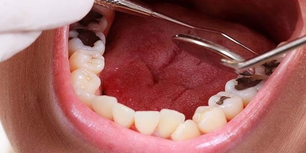 Diş eti sorunlarını ihmal etmeyin! Daha ciddi problemlerin habercisi olabilir