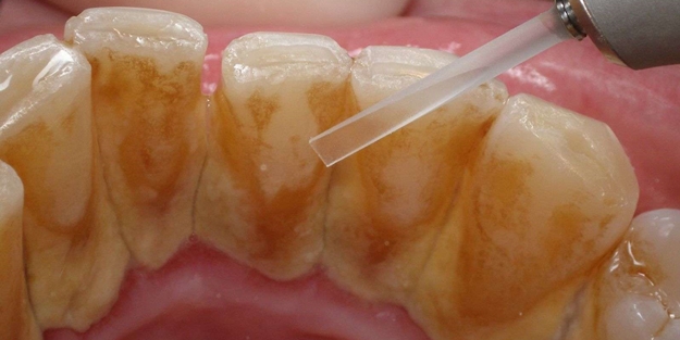 Diş etinden girip tüm vücuda yayılıyor! Görürseniz hemen...