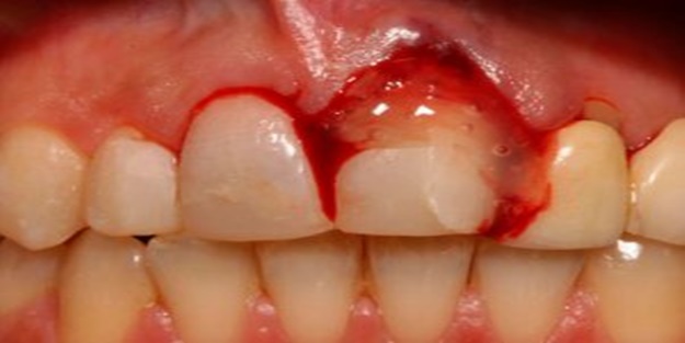 Diş etleri neden kanar?