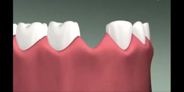 Diş implantı nasıl yapılıyor?